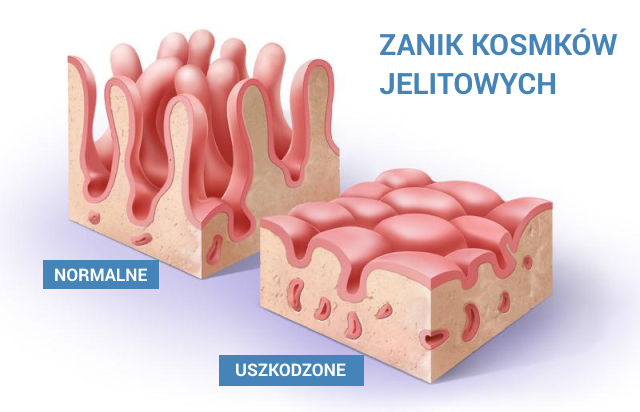celiakia zanik kosmków jelitowych 